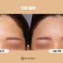 광주이마필러? 봉긋한 이마 핵심은 2가지입니다 [병원작성]