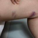 교보생명보험(주) - 안산시 단원구 | 40대 하지정맥류 증상부터 수술까지 리얼 후기 (수술비용/통증/입원/실비)