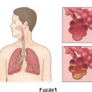 폐렴 초기증상 폐렴에 좋은음식 예방법 치료 이미지