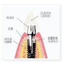 임플란트와 임플란트 관리법 이미지
