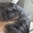 압구정 탈모치료 헤어셀 모낭주사 2차 후기