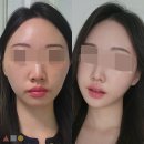 V-3 | 광대축소술 미니v 무턱 수술 전후 안면윤곽 3개월 후기