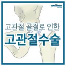 고관절 골절 노인, 인공관절수술 늦으면 사망할 수도 이미지