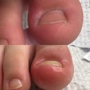 논산 7세 어린이 내성발톱 교정후기!논산 전문샵 네일박스!논산 네일박스에서 내성 발톱관리하세요,논산...
