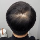 채움남성의원 | 리앤채움의원 남성 정수리 탈모 두피문신 후기