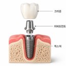 박정열치과의원 | 가평치과, 임플란트 가격이 병원마다 다른 진짜 이유 [16년 차 의사 작성]