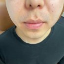 더블유피부과의원 | 부산 하단 피부과 더블유의원 남자 인중, 턱 레이저 제모 시술 후기/통증/비용