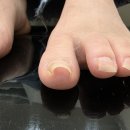 루덴풋케어닥터아이티엔 | 송파 석촌 내성발톱 심하게 파고들던 발 해결 루덴풋케어 내성발톱 무좀 발각질 문제성발