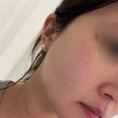 월촌문고(출입구 앞) | 창원피부과 코어톡스 스킨보톡스 솔직후기 통증