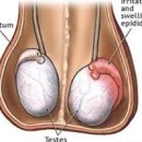 고환염 , 부고환염 (왼쪽 고환 통증, 음낭 부종, 발열) 이미지