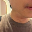 부천신경내외의원 | 남자레이저제모 6회차 후기｜부천 블리비의원에서 꾸준히 받아본 솔직한 변화
