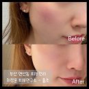 연산LG제2경로당 | [부산 연산동 피부관리] 최정윤 피부연구소 | 세민시트관리 | 예민 홍조피부에서 말끔 물광 피부로
