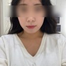 바노바기의원 창원 레이저 리프팅 세르프 솔직 후기!