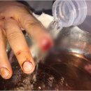 수지접합 실력 좋으신 의사선생님 계신 뉴스타트병원에서 치료 받으세요.