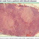 목 임파선염 기꾸찌병 (기쿠치병) 원인 증상은 무엇 이미지
