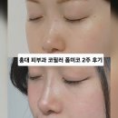 NO.1 자동차피부과 | 홍대피부과 코필러 폼미코 로리앙필러 당일부터 2주 후기