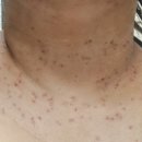 [리뷰] 편사성지 자연튼튼의원 방문 후기 2탄_쥐젖편사제거&amp;비포애프터
