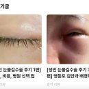 [성인 눈물길수술 4편] 실리콘관 제거 후기