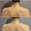 오비스디자인 | 안양범계신부관리 씨엘오비스 승모근 팔뚝 집중 관리 비포애프터 후기