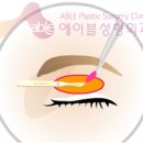 [에이블성형외과] 눈처짐 - 상안검 수술방법 이미지