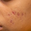 전혜주피부과의원 | 서초구 피부과 여드름흉터에 따른 레이저 치료방법