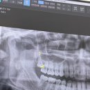 미사바른치과의원 | 사랑니 발치 천재.. 미사역 연세바른치과 2번 발치 후기