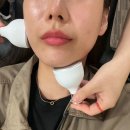 결혼준비 14. 이중턱살 윤곽주사 비너스 달걀주사 후기 통증 가격
