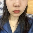 서대규제니스의원 | 대구 본리동 서대규 제니스 의원 : 코레지에그 리프팅 받은 후기