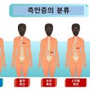 척추측만증 원인 방법 척추 옆굽음증 이미지