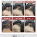 강민재헤어클럽 | 포기하신 탈모고민 마지막 발모희망 마지막 도전에 지파동수샴푸 어떠신가요?