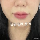 압구정 입술필러 에이포의원 내돈내산 리얼후기