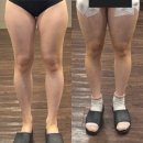 더멍 | 혜화 허벅지 무한람스 당일 찐 후기(시술 통증, 멍, 붓기, 꿀팁 정리)