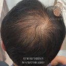 분당종합시장 | [분당두피문신잘하는곳] 정수리탈모, 예방을 놓쳐도...50대 남성의 파우더기법 두피문신 리얼 후기)