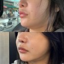 지오치과의원 | 비너스 달걀주사 맞고 이중턱 투턱 볼살 심부볼 없앤 솔직후기