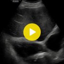 pleural effusion from fribrosis and cancer of lung(폐암으로부터 흉막 삼출액) 이미지