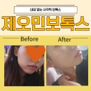이후정 | 제오민 사각턱보톡스 후기 효과 1개월 후