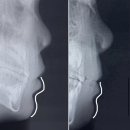 민치과의원 | 압구정민치과 어린이 6세 프랑켈 치아교정 1년 2개월