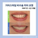 스마일 Smile | 거미스마일(gummy smile) 20대 직장인 비수술 치아 교정 후기