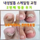 쌍용제1차㉵ | 천안 내성발톱 스케일링 교정 2번째 방문 후기 오루아레푸스 천안쌍용점