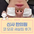 선명한의원 | 신사역 한의원 코 모공시술 새살침 후기