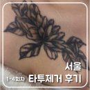 강서 효 | [서울/강서] 문신제거 솔직후기/ 내돈내산 타투제거 후기/ 타투제거 비용/ 1-4회차
