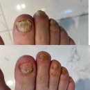 [에이민네일&amp;오로지푸스 대구 황금점] 대구 수성구...발톱 관리 잘하는 곳 정보, 후기, 가격, 홈케어 방법