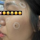 편평사마귀 점빼고 관리 레이저시술 후 재생크림 추천