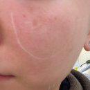 평생피부과동물병원 | 성수피부과 홍조 탄력 위한 티타늄 콰트로리프팅 후기