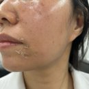 (주)성안개발 | 울산 피부관리 위크원 NEW!! 바이오리필 하이브리드 AI 필링 관리방법