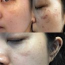 양주피부관리 로덱스스킨앤왁싱 잡티 고민 정돈 관리 후기