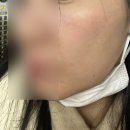 리쥬란후기! 아플까봐 무서워 근데 나빼고 다받는 리쥬란..비포앤애프터 후기