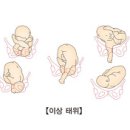 난산(Dystocia) 여성질환이란? 이미지