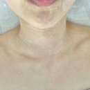 호인메디칼 | [전주 피부관리] 차올라 메디컬 스킨케어에서 하이푸 리프팅 받은 후기