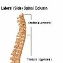 척추 전만증 이미지